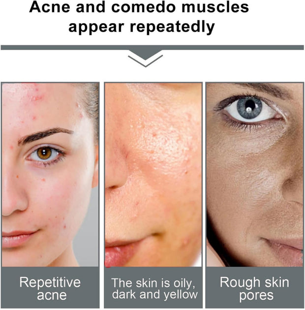 2Pcs Mandelic Acid 10% Ha,Gentle Skin Exfoliator for Face,Hyaluronic Acid Serum to Improve Dull Skin,Face Dry Skin Care Moisturizer,Face Serum to Moisturizing Control Excess Oil,Serum for Woman