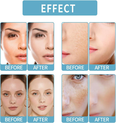 Gla-Mory Micro Infosion System for Lips,Gla-Mory Micro System for Face,Facial System with Serum,Hyaluronic Acid Serum,Hyaluronic Acid Serum for Face,Hydrating Serum,Collagen Serum for Face,10Ml